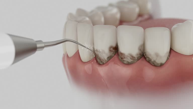 Trusted Wisdom Tooth Removal service in Warson Woods, MO - Dentist Open Now